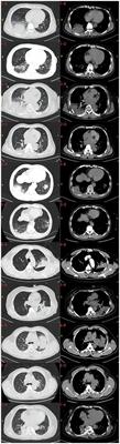 Clinical diagnosis and treatment of seven patients diagnosed pneumonia caused by Chlamydia abortus: a case series report